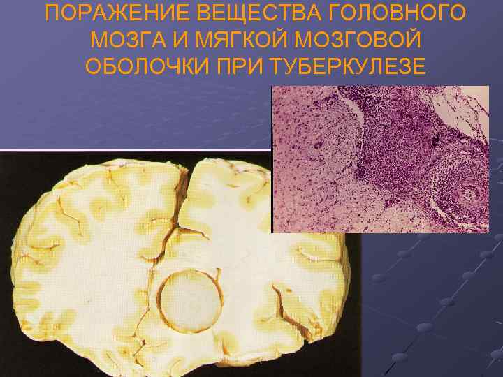 ПОРАЖЕНИЕ ВЕЩЕСТВА ГОЛОВНОГО МОЗГА И МЯГКОЙ МОЗГОВОЙ ОБОЛОЧКИ ПРИ ТУБЕРКУЛЕЗЕ 