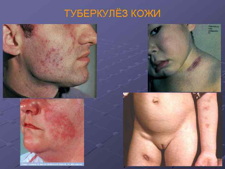 ТУБЕРКУЛЁЗ КОЖИ 