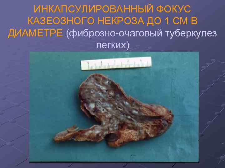 ИНКАПСУЛИРОВАННЫЙ ФОКУС КАЗЕОЗНОГО НЕКРОЗА ДО 1 СМ В ДИАМЕТРЕ (фиброзно-очаговый туберкулез легких) 