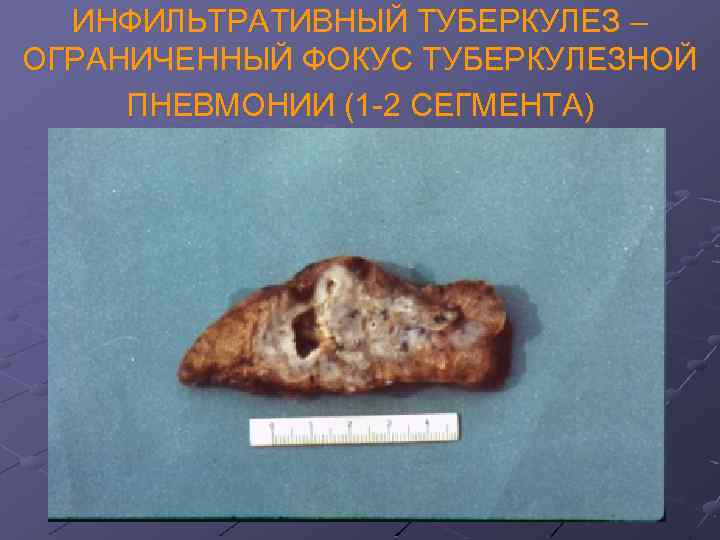 ИНФИЛЬТРАТИВНЫЙ ТУБЕРКУЛЕЗ – ОГРАНИЧЕННЫЙ ФОКУС ТУБЕРКУЛЕЗНОЙ ПНЕВМОНИИ (1 -2 СЕГМЕНТА) 