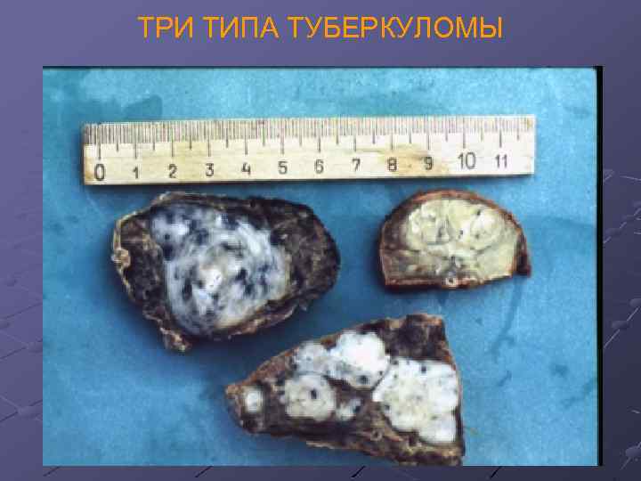 ТРИ ТИПА ТУБЕРКУЛОМЫ 