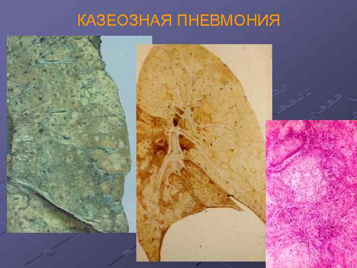 КАЗЕОЗНАЯ ПНЕВМОНИЯ 