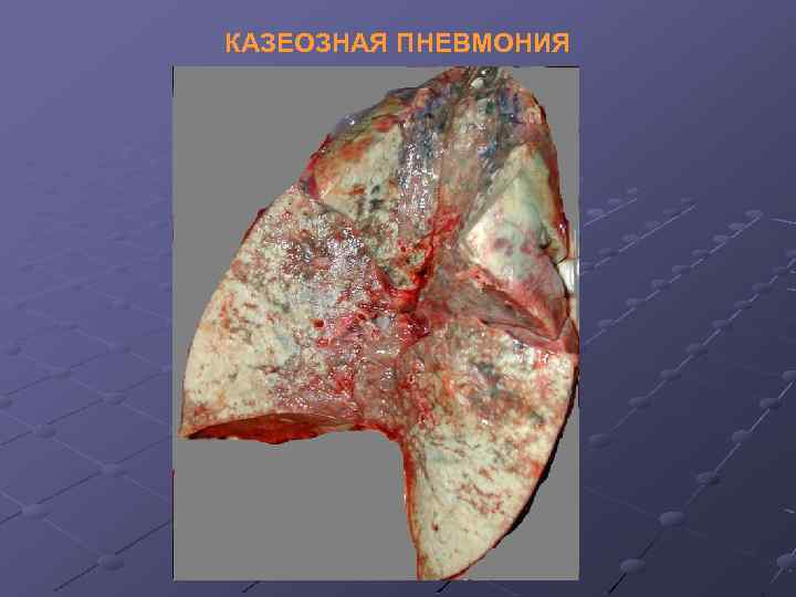 КАЗЕОЗНАЯ ПНЕВМОНИЯ 