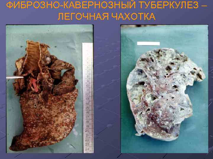 ФИБРОЗНО-КАВЕРНОЗНЫЙ ТУБЕРКУЛЕЗ – ЛЕГОЧНАЯ ЧАХОТКА 