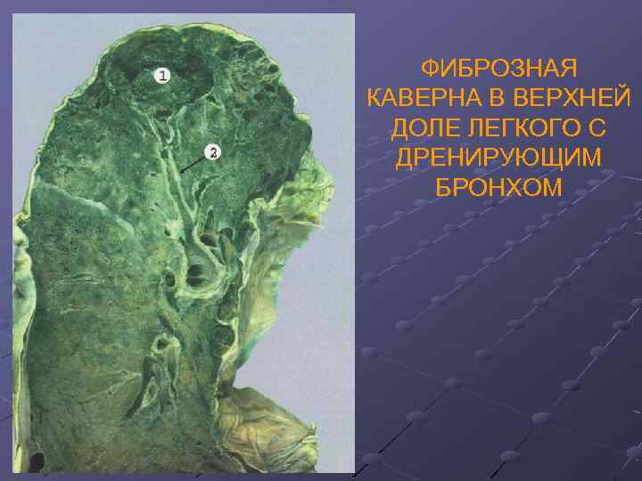 ФИБРОЗНАЯ КАВЕРНА В ВЕРХНЕЙ ДОЛЕ ЛЕГКОГО С ДРЕНИРУЮЩИМ БРОНХОМ 