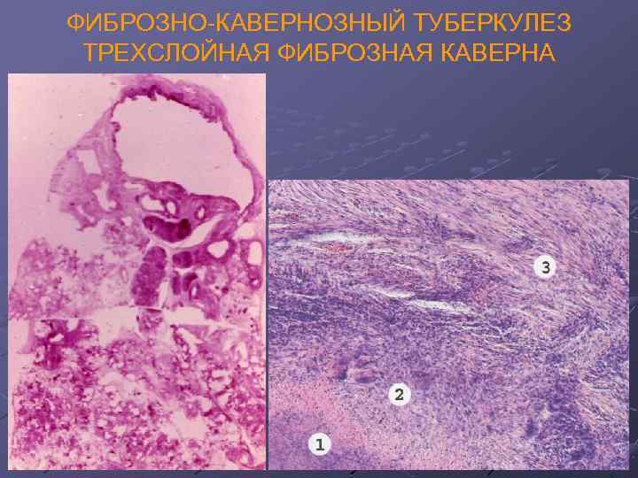 ФИБРОЗНО-КАВЕРНОЗНЫЙ ТУБЕРКУЛЕЗ ТРЕХСЛОЙНАЯ ФИБРОЗНАЯ КАВЕРНА 