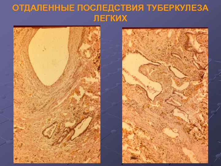 ОТДАЛЕННЫЕ ПОСЛЕДСТВИЯ ТУБЕРКУЛЕЗА ЛЕГКИХ 