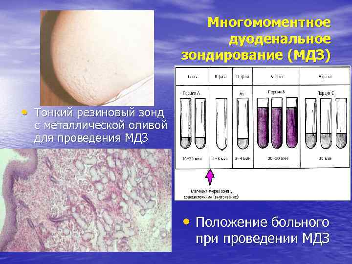 Многомоментное дуоденальное зондирование (МДЗ) • Тонкий резиновый зонд с металлической оливой для проведения МДЗ