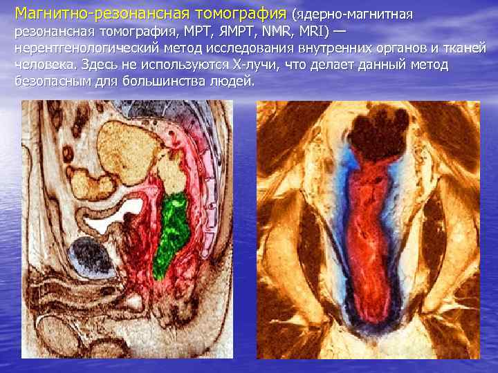 Магнитно-резонансная томография (ядерно-магнитная резонансная томография, МРТ, ЯМРТ, NMR, MRI) — нерентгенологический метод исследования внутренних