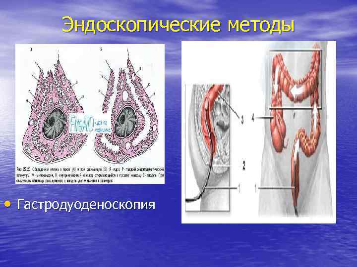 Эндоскопические методы • Гастродуоденоскопия 