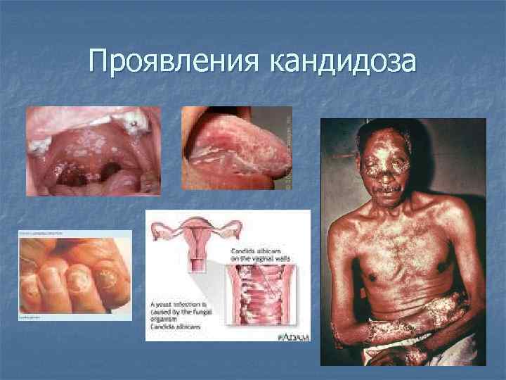 Проявления кандидоза 