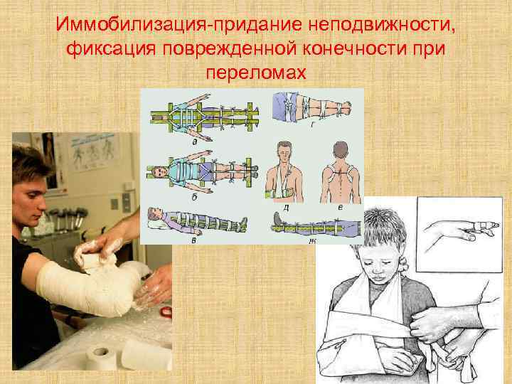 Иммобилизация-придание неподвижности, фиксация поврежденной конечности при переломах 