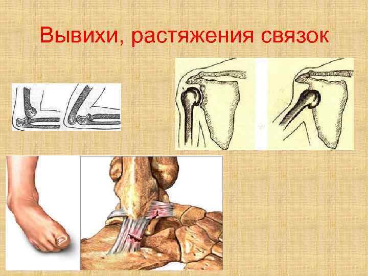 Вывихи, растяжения связок 