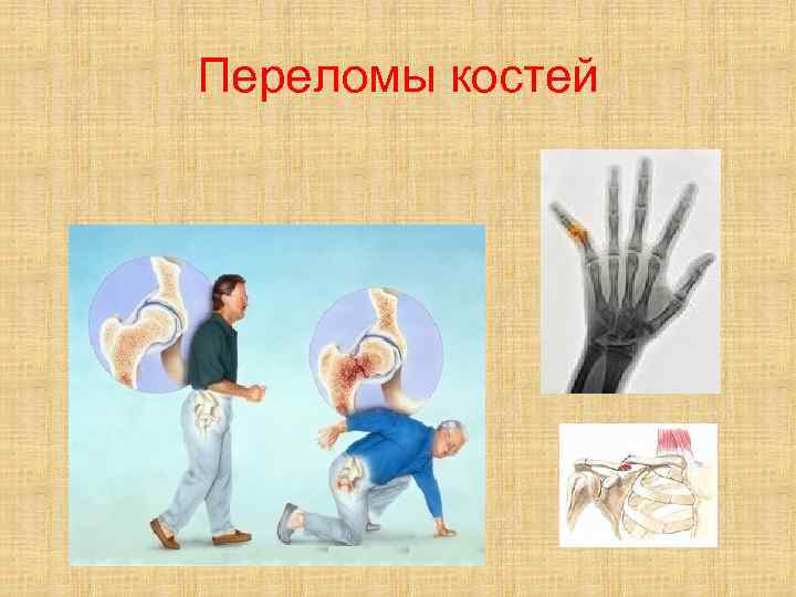 Переломы костей 