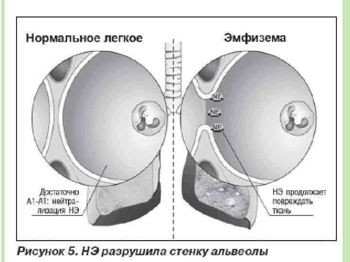 Дефицит альфа 1 антитрипсина у детей презентация