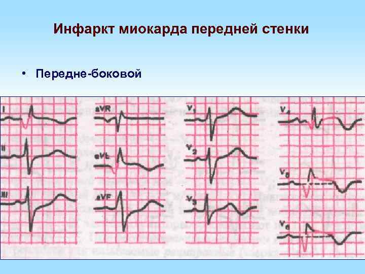 Инфаркт миокарда передней стенки • Передне-боковой 