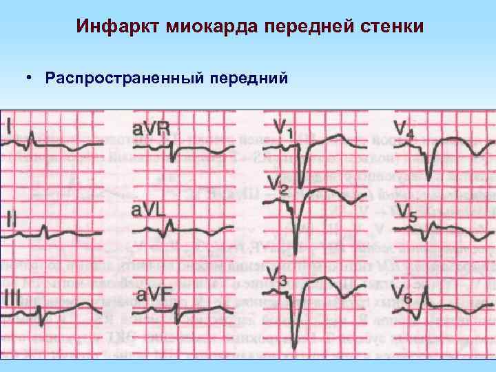 Инфаркт миокарда передней стенки • Распространенный передний 