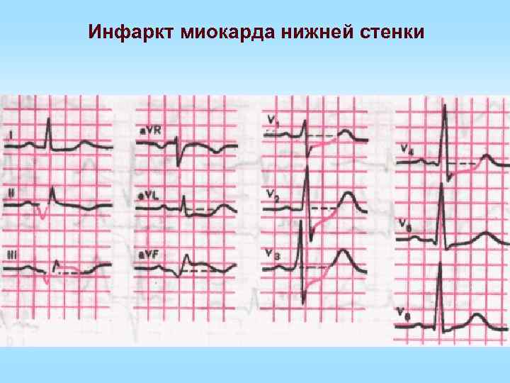 Инфаркт миокарда нижней стенки 