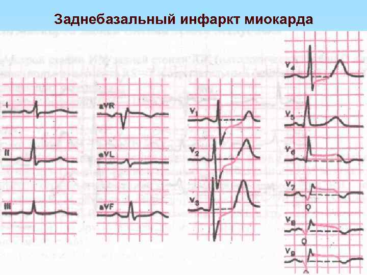 Заднебазальный инфаркт миокарда 