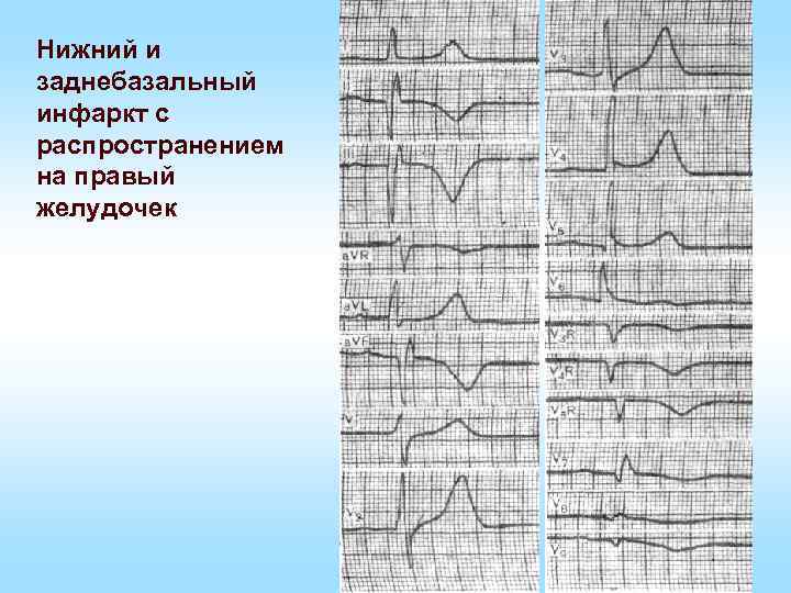 Нижний и заднебазальный инфаркт с распространением на правый желудочек 