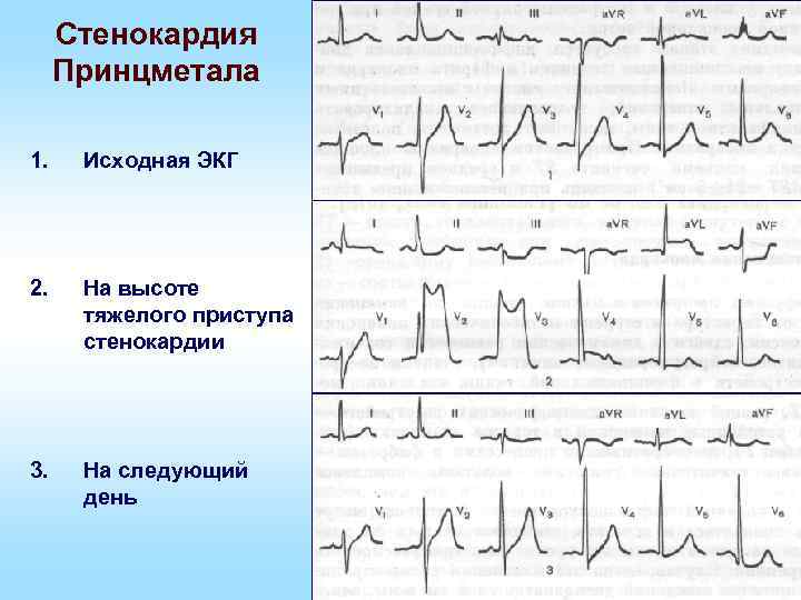 Стенокардия Принцметала 1. Исходная ЭКГ 2. На высоте тяжелого приступа стенокардии 3. На следующий