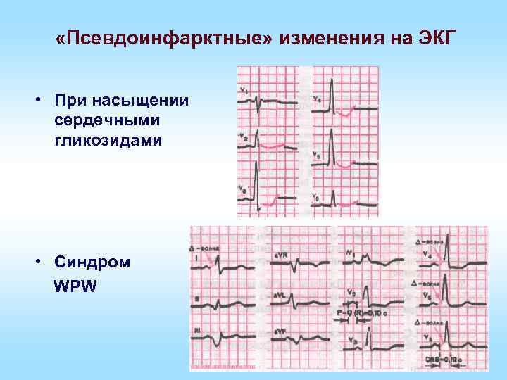 «Псевдоинфарктные» изменения на ЭКГ • При насыщении сердечными гликозидами • Синдром WPW 