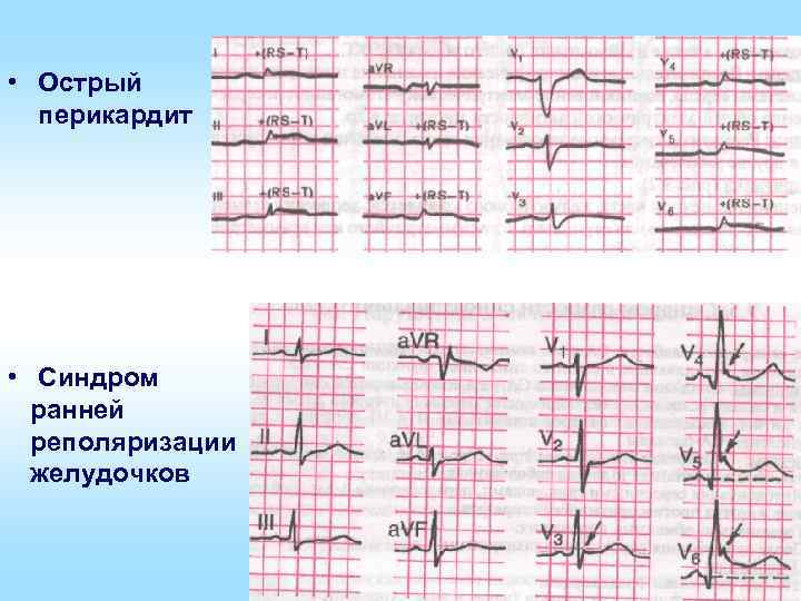  • Острый перикардит • Синдром ранней реполяризации желудочков 