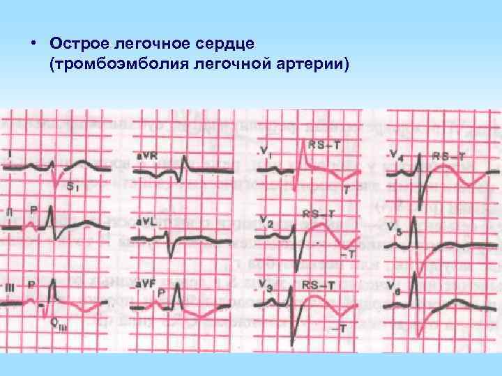  • Острое легочное сердце (тромбоэмболия легочной артерии) 