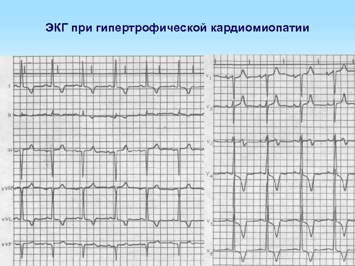 ЭКГ при гипертрофической кардиомиопатии 