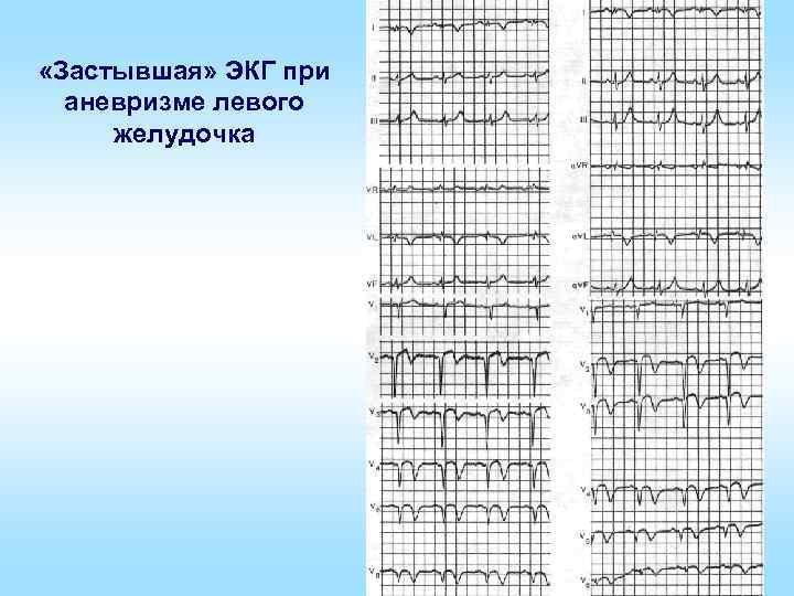  «Застывшая» ЭКГ при аневризме левого желудочка 