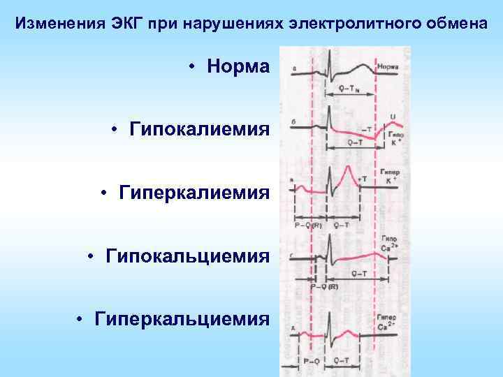 Изменения ЭКГ при нарушениях электролитного обмена • Норма • Гипокалиемия • Гиперкалиемия • Гипокальциемия