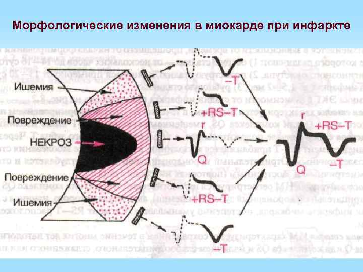 Морфологические изменения в миокарде при инфаркте 