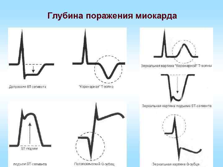 Глубина поражения миокарда 