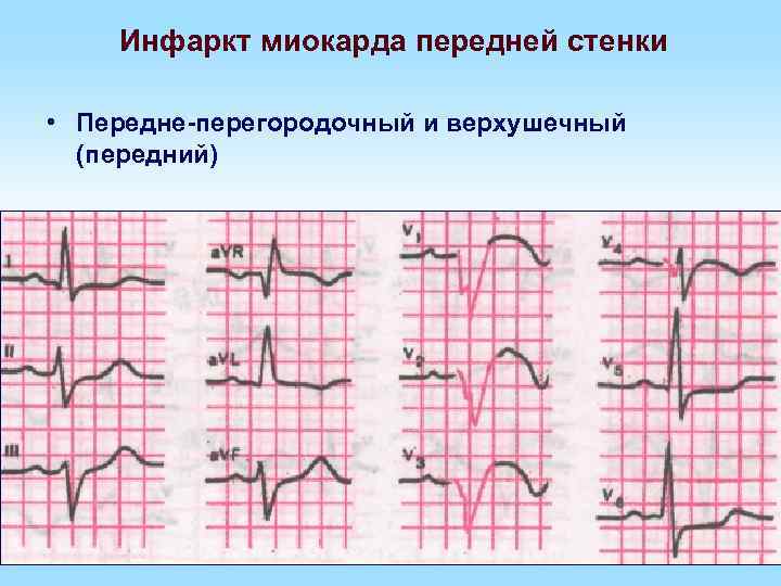 Инфаркт миокарда передней стенки • Передне-перегородочный и верхушечный (передний) 