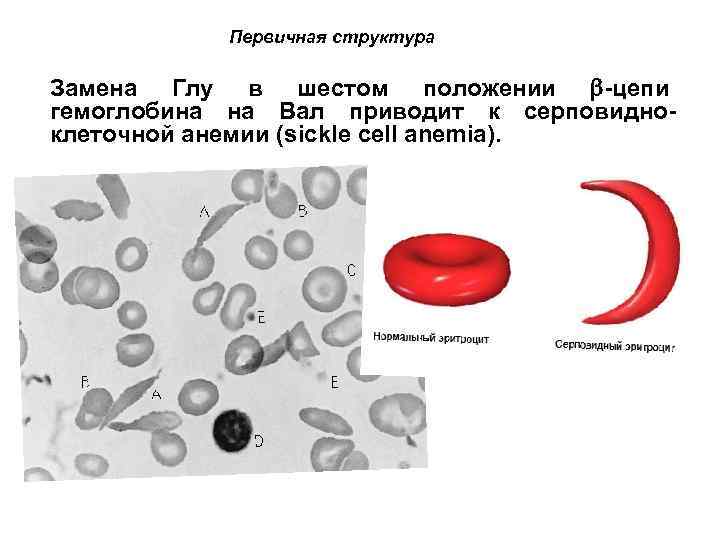 Первичная структура Замена Глу в шестом положении -цепи гемоглобина на Вал приводит к серповидноклеточной