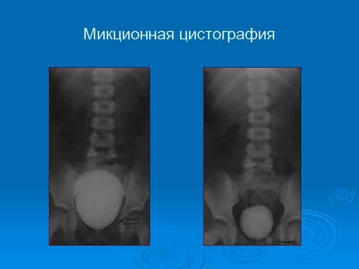 Микционная цистография 
