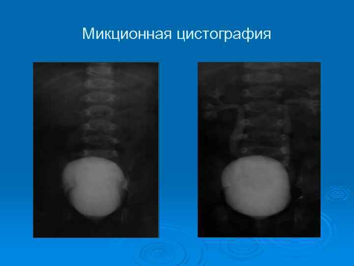 Цистография подготовка. Микционная цистоуретрография. Пузырно-мочеточниковый рефлюкс цистоуретрография. Пузырно-мочеточниковый рефлюкс МЦУГ.