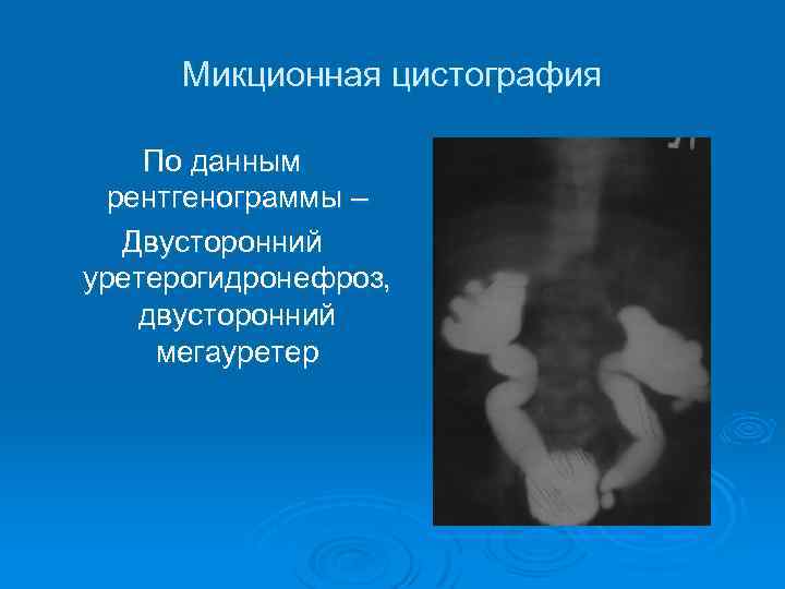 Микционная цистография фото