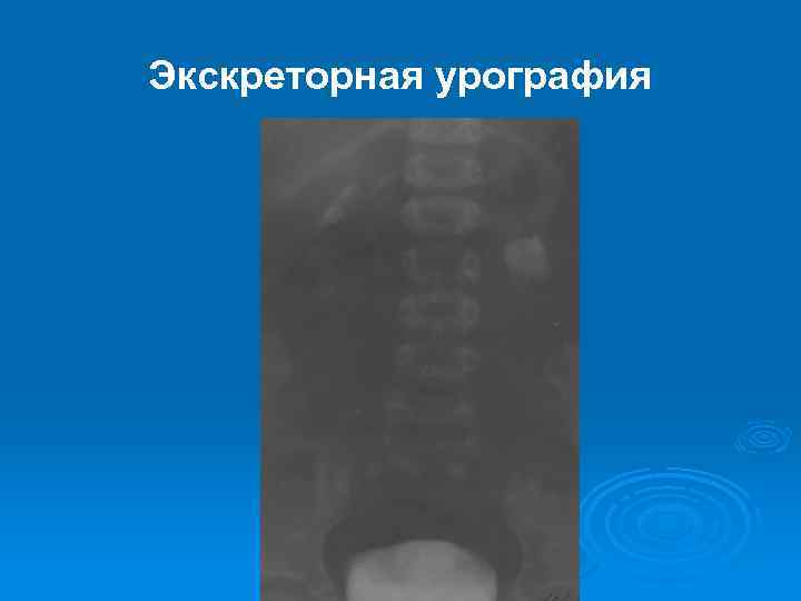 Экскреторная урография 