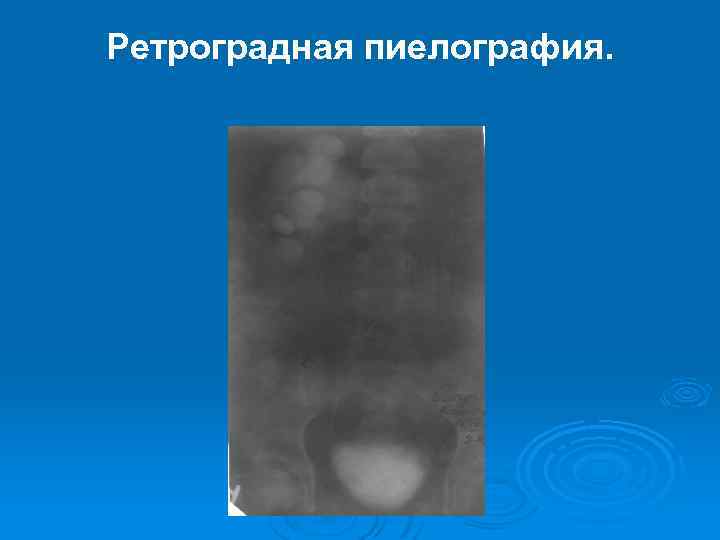 Ретроградная пиелография. 