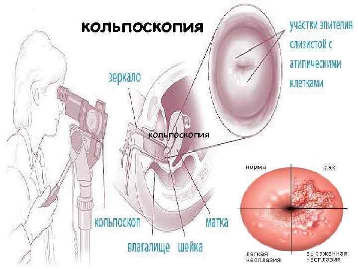 кольпоскопия 