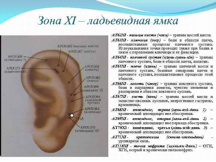 Зона XI – ладьевидная ямка AT 62 XI - пальцы кисти (чжи) – травмы