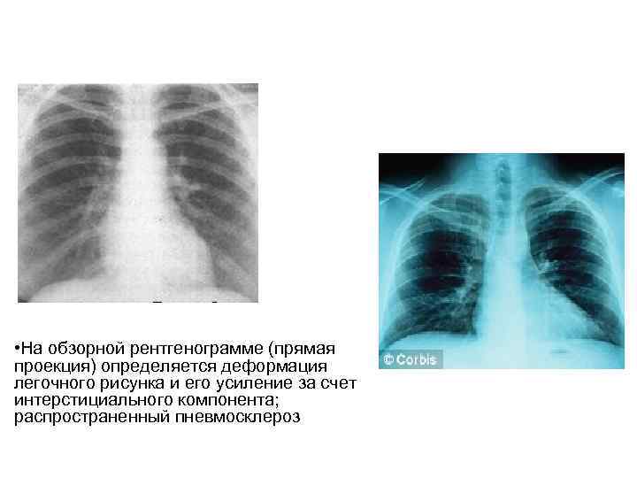 Усиление прикорневого легочного рисунка. Деформация легочного рисунка на рентгене. Пневмосклероз рентгенограмма. Пневмосклероз рентген. Рентгеновские снимки пневмофиброз.