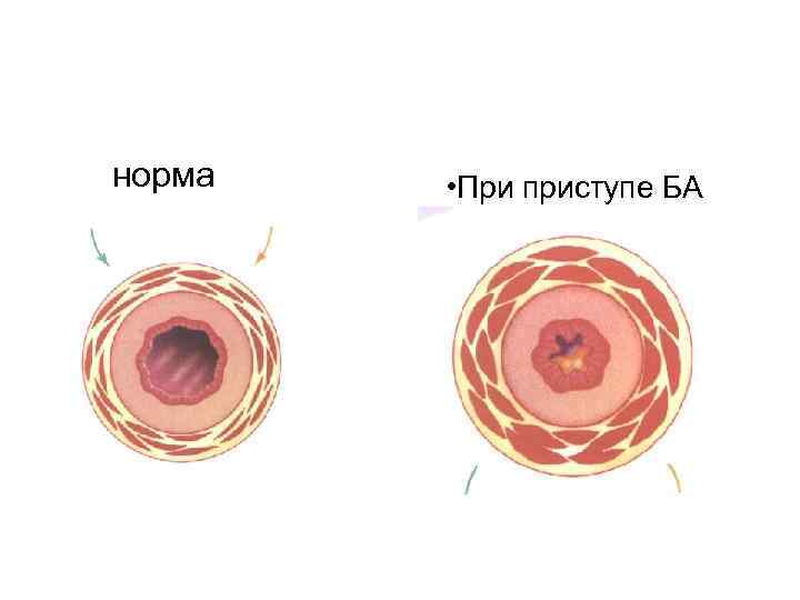 норма • При приступе БА 