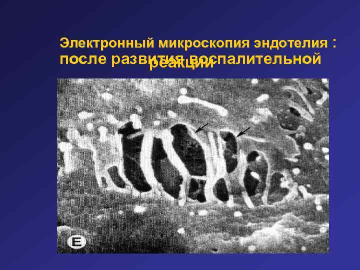 Электронный микроскопия эндотелия : после развития воспалительной реакции 