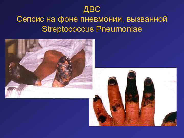 ДВС Сепсис на фоне пневмонии, вызванной Streptococcus Pneumoniae 