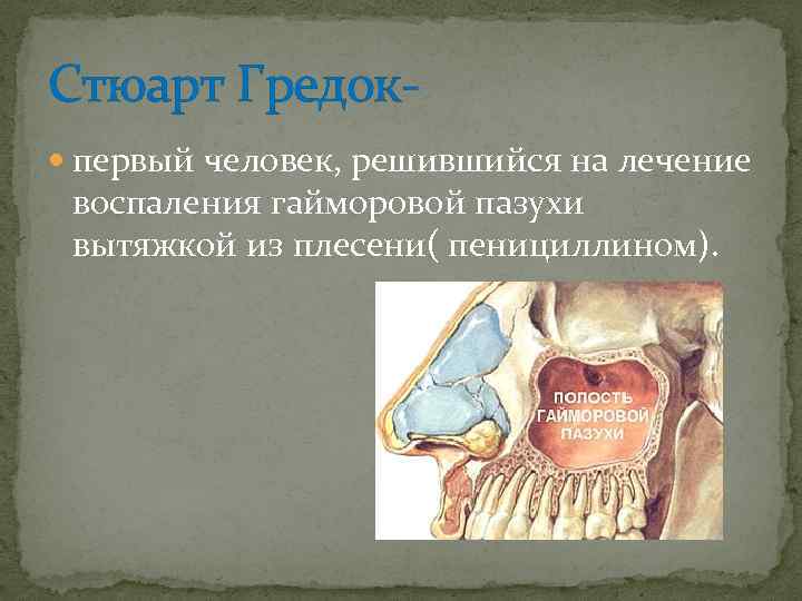 Стюарт Гредок первый человек, решившийся на лечение воспаления гайморовой пазухи вытяжкой из плесени( пенициллином).