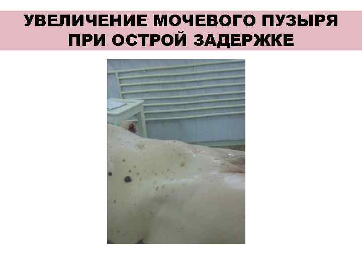 УВЕЛИЧЕНИЕ МОЧЕВОГО ПУЗЫРЯ ПРИ ОСТРОЙ ЗАДЕРЖКЕ 