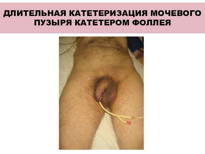 ДЛИТЕЛЬНАЯ КАТЕТЕРИЗАЦИЯ МОЧЕВОГО ПУЗЫРЯ КАТЕТЕРОМ ФОЛЛЕЯ 