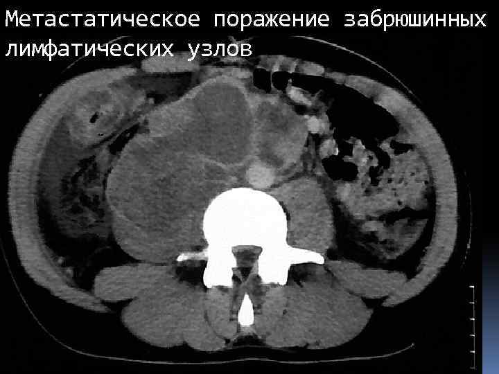 Метастатическое поражение забрюшинных лимфатических узлов 